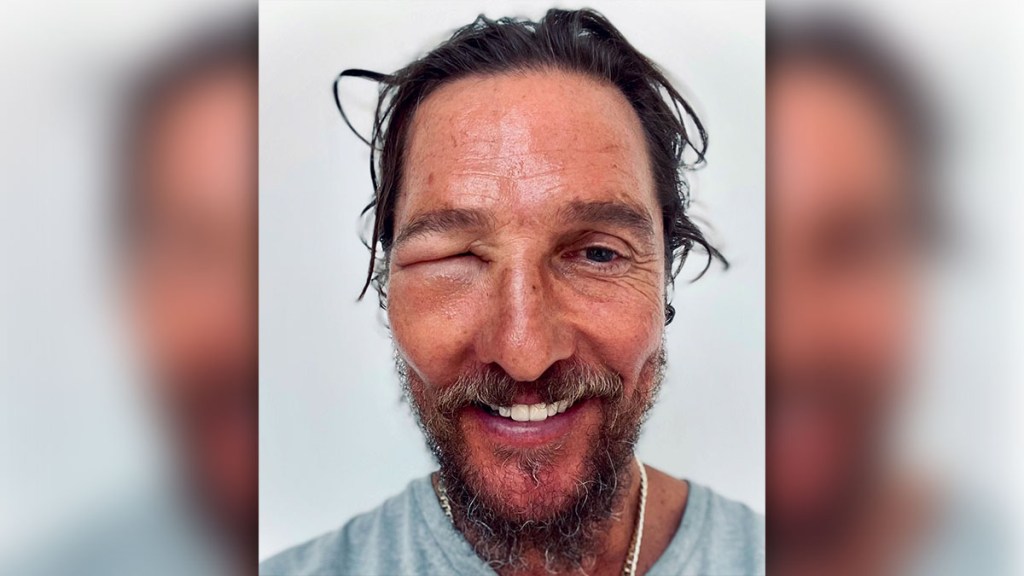 Matthew McConaughey Bee Sting Eye